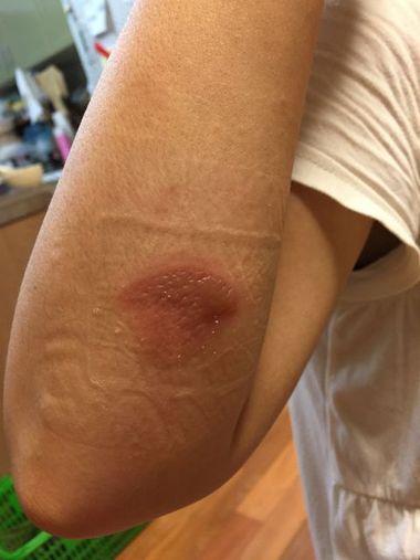 やけどに酵素? やけどに酵素?