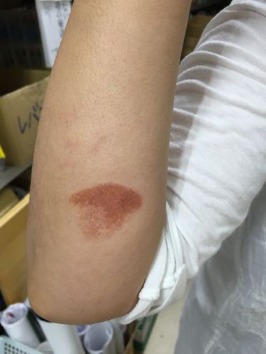 やけどに酵素? やけどに酵素?