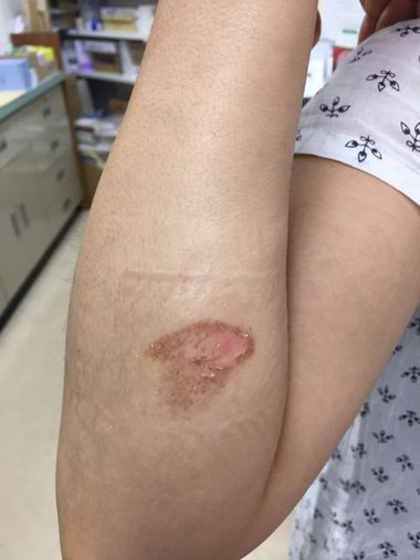 やけどに酵素? やけどに酵素?
