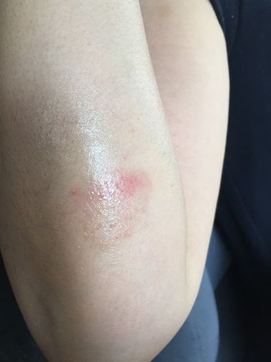 やけどに酵素? やけどに酵素?