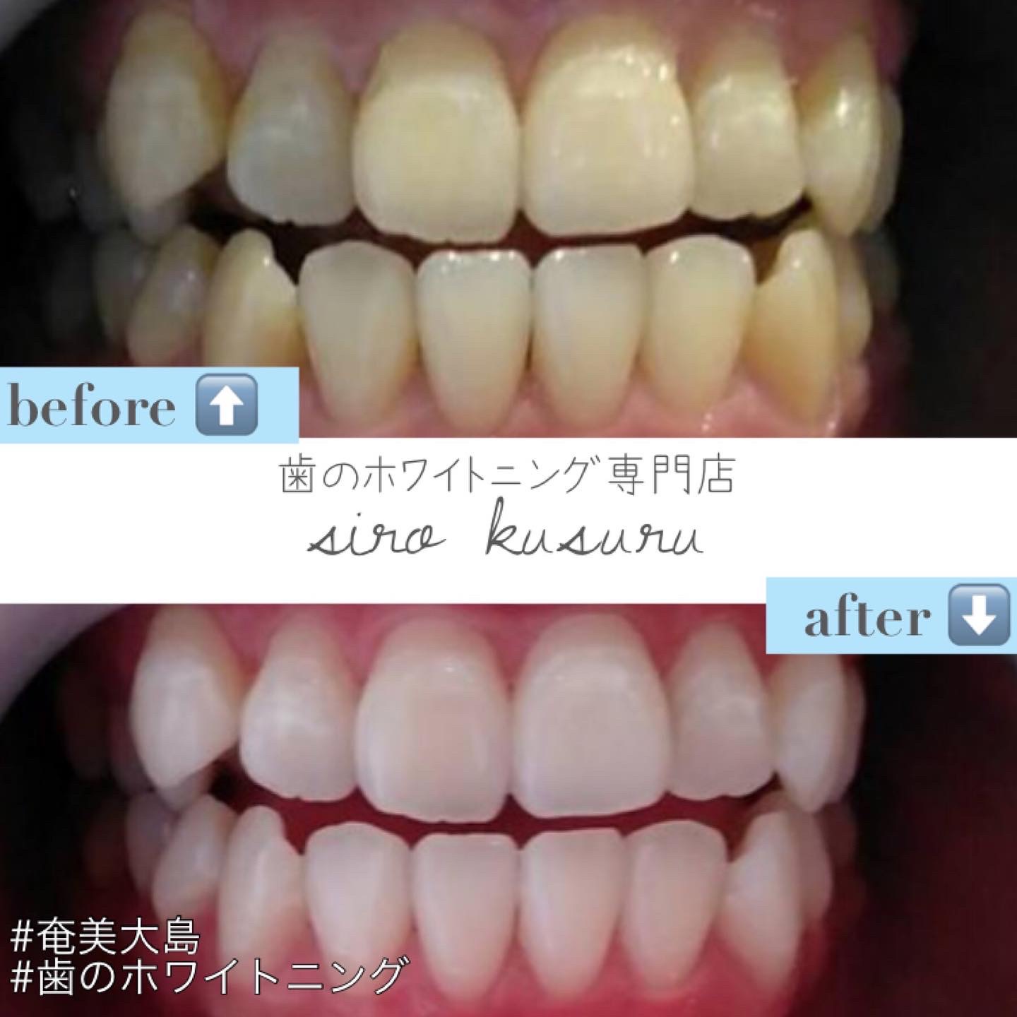 セルフホワイトニングで実感❗ セルフホワイトニングで実感❗