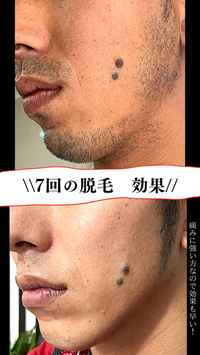 ヒゲ脱毛の効果
